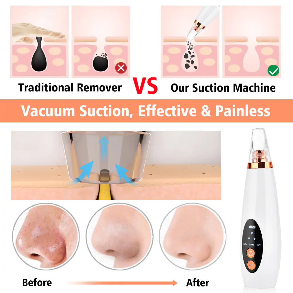 Electric Blackhead Removing Device